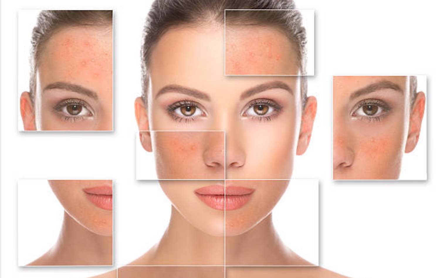oily and acne-prone skin